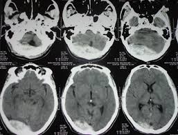 Thiếu hụt yếu tố V Leiden - Hình ảnh minh họa